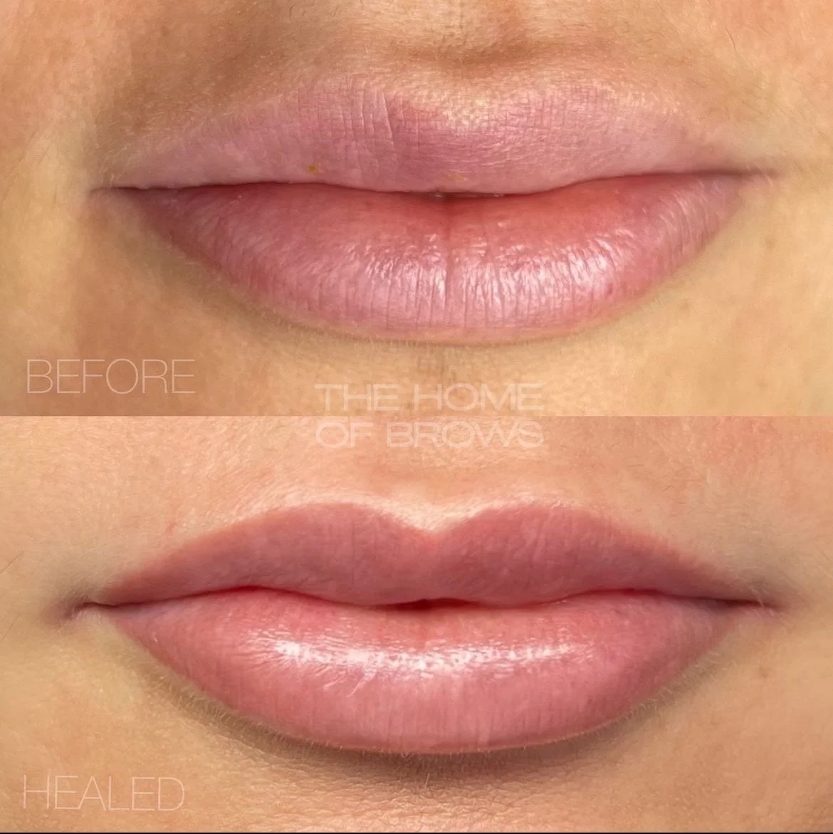 Close-up comparison of lips before and after brow treatment, showing smooth and fuller lips post-treatment.