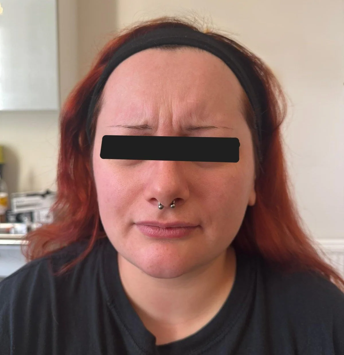 NB Before treatment
