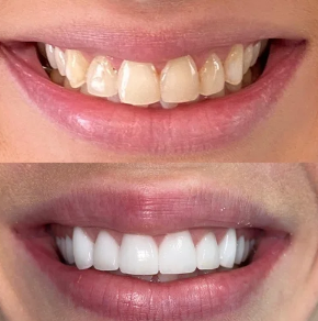 Comparison of a person's teeth before and after dental whitening, showing improved whiteness and alignment.