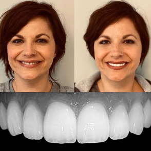 Before and after photos of a woman's smiling face, showing dental transformation, along with a close-up of her teeth.