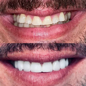 Close-up of a person's smile showing teeth before and after dental whitening, with unaligned, stained teeth above and straight, white teeth below.