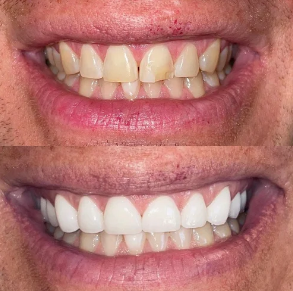 Comparison of teeth before and after dental treatment showing improved whiteness and alignment.