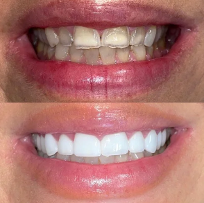 Comparison of a person's teeth before and after dental treatment, showing stained and uneven teeth in the top image and white, straight teeth in the bottom image.