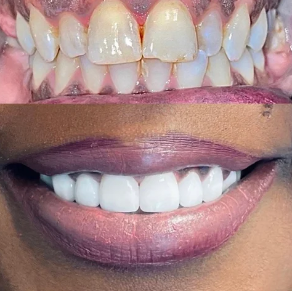 Close-up of a person's teeth before and after dental whitening, showing improvement in tooth color.