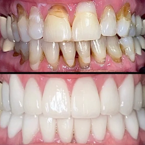 Comparison of teeth before and after dental cleaning and whitening showing improvements in color, cleanliness, and overall appearance.