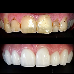 Comparison of teeth before and after dental treatment; the top image shows discolored, decayed teeth, and the bottom image shows healthy, white, and well-aligned teeth.
