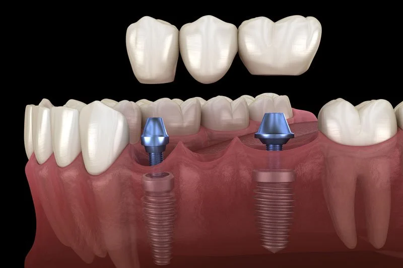 Byrne Dental