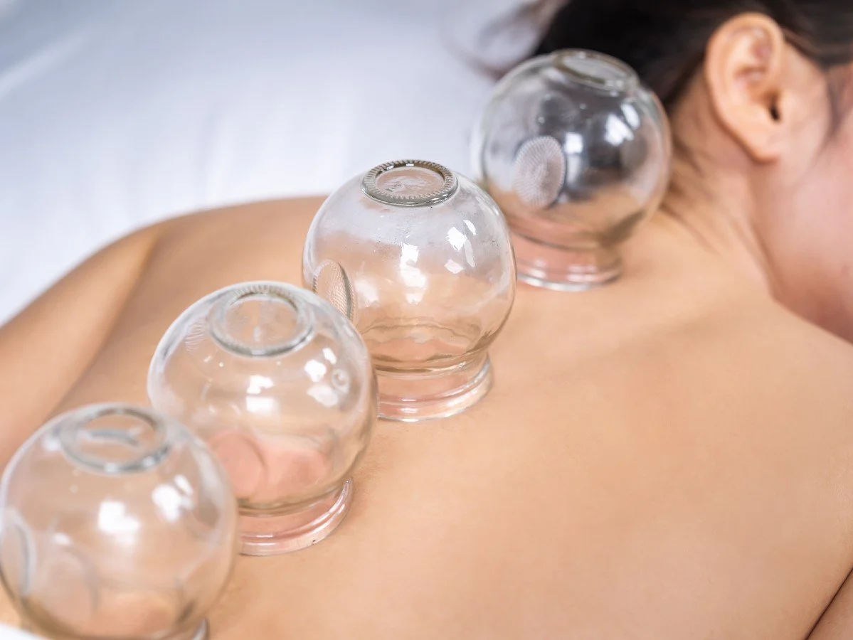 Person receiving a cupping therapy treatment with several glass suction cups on their back.