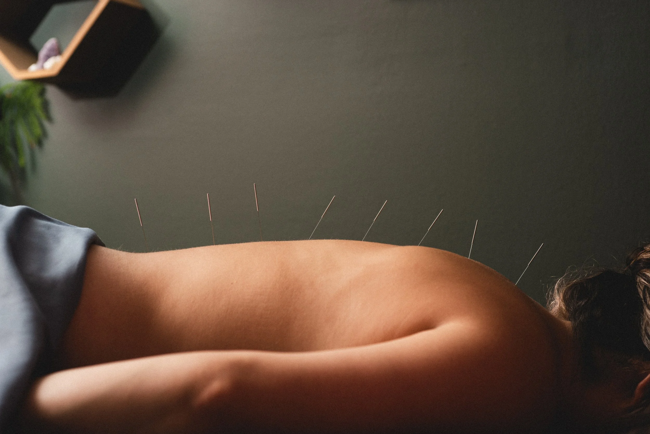 Person lying face down while receiving acupuncture treatment, with thin sterile needles inserted along the person's back.