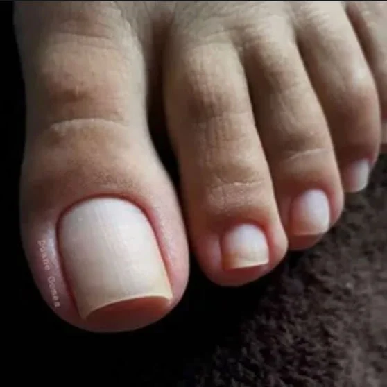 Close-up of big toe, second toe, and toenails showing thickened and discolored toenails.