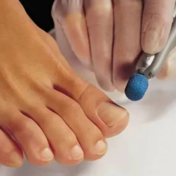 Close-up of a person's toes being examined or treated by a healthcare professional using a small medical tool with a blue tip.