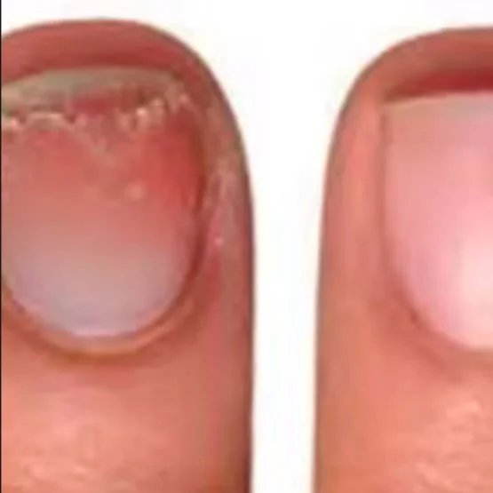 Close-up of two fingernails, with the left nail showing damage or debris and the right nail appearing healthy.