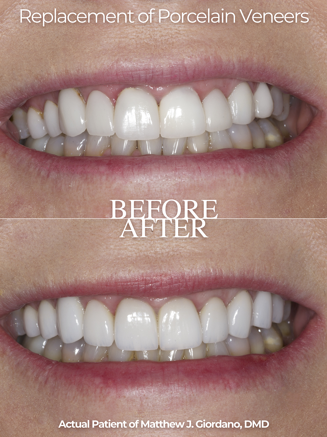 replacement of porcelain veneers before and after photo from Matthew Giordano, DMD of Atlanta Dental Wellness