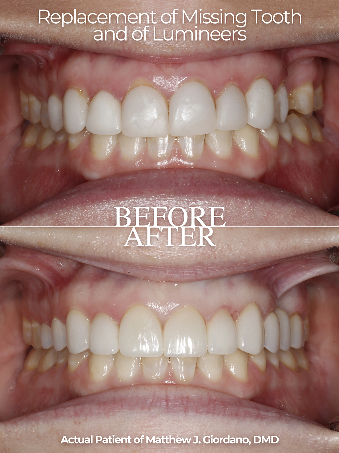 replacement of missing tooth and of Lumineers before and after photo from Matthew Giordano, DMD of Atlanta Dental Wellness
