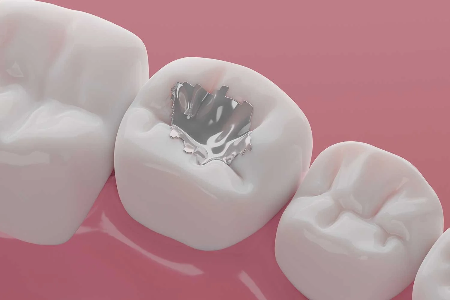 Dental Amalgam and Mercury: What the FDA Guidance Means Today