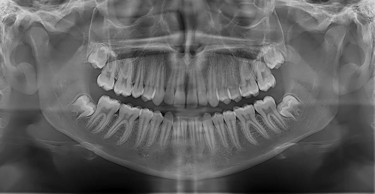 Dental X Rays and Radiation: What Patients Should Know