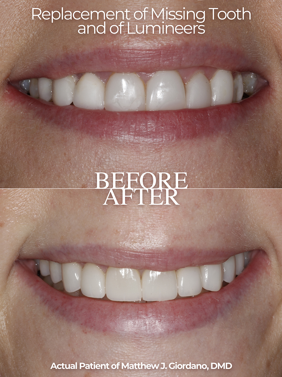 replacement of missing tooth and of Lumineers before and after photo from Dr. Matthew Giordano of Atlanta Dental Wellness