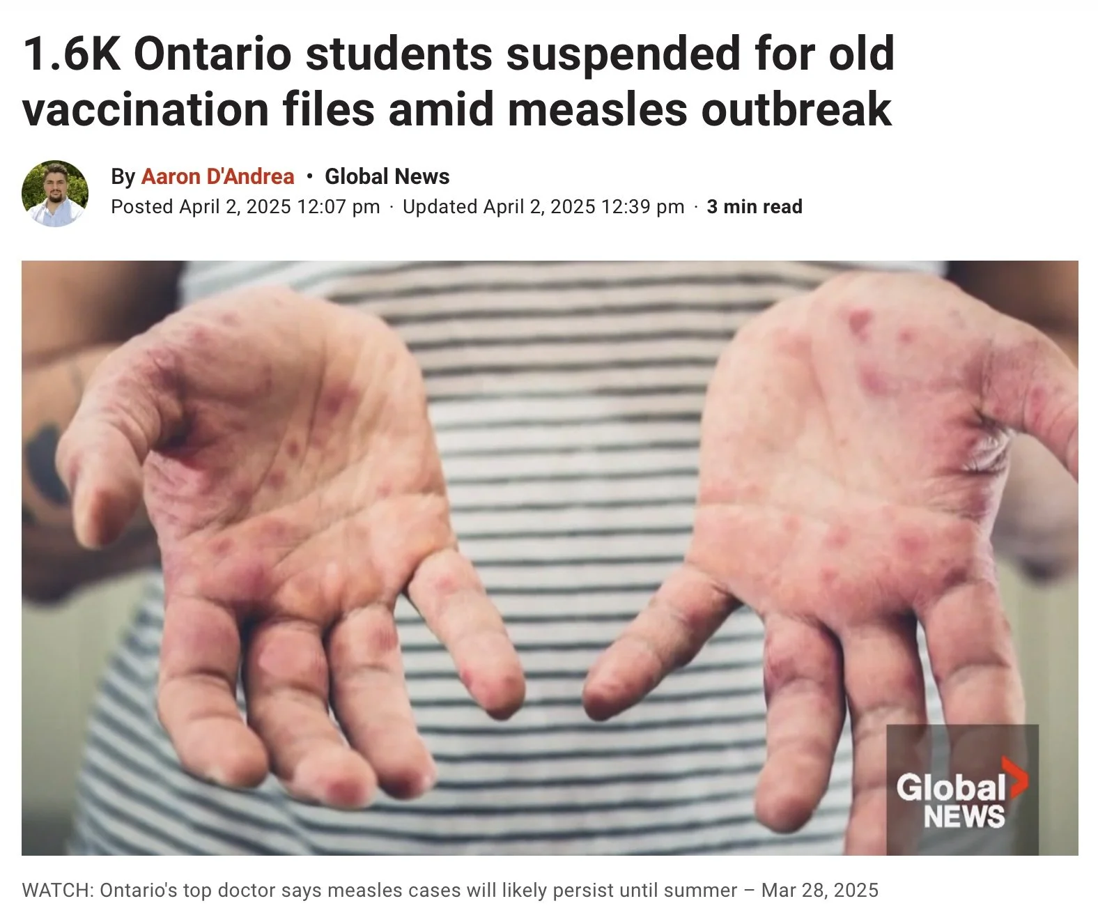 Measles Outbreak in Ontario Sparks Student Suspensions: What Parents Need to Know
