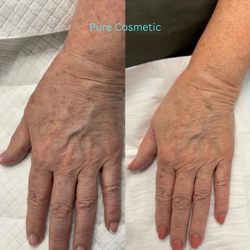 Have a look at these amazing results with only one Limelight (IPL) Treatment. Book in your Consultation Today !