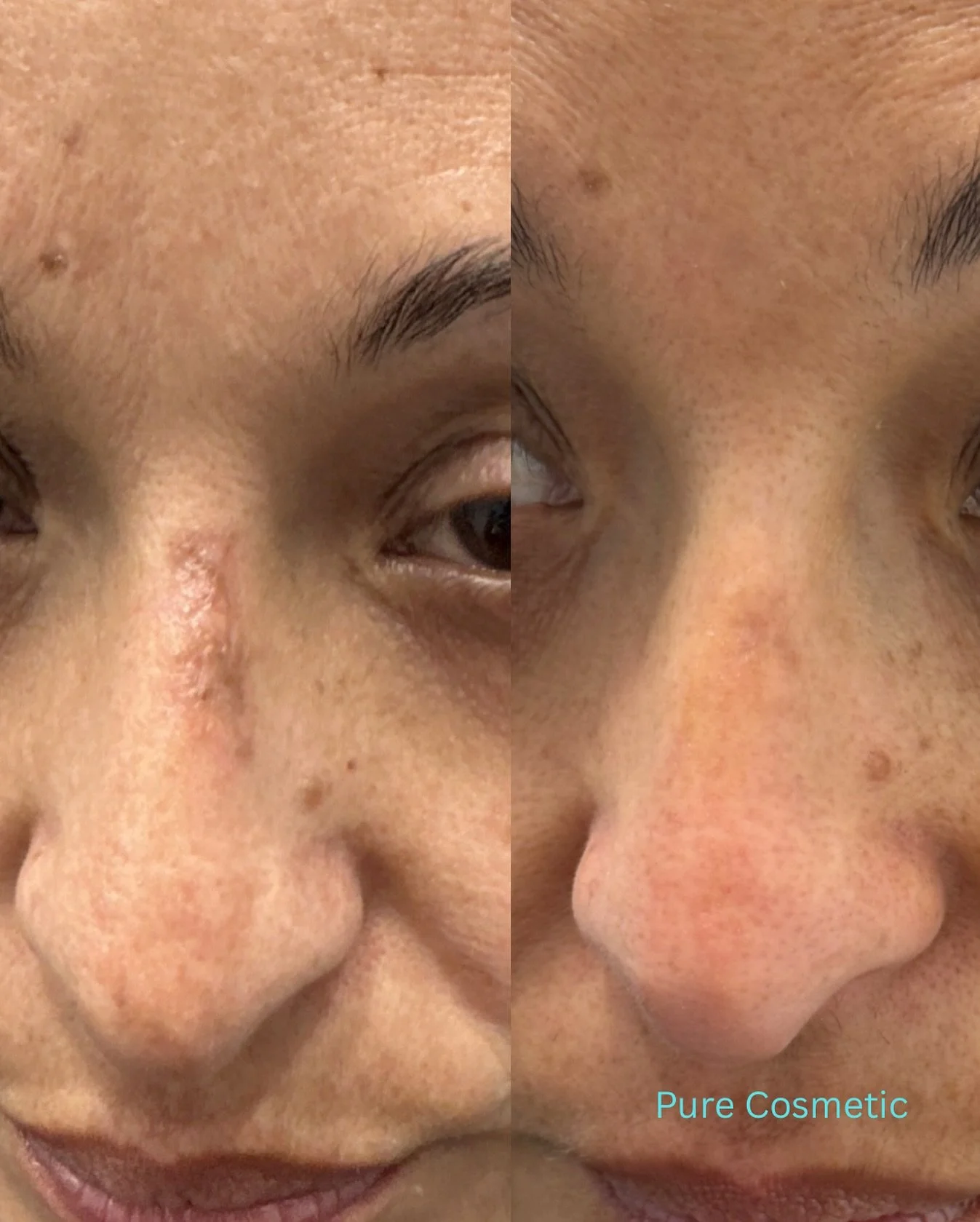 With a combination of MLA and Pico Genesis, we were able to achieve these amazing results. Book your consultation today to create your personalised treatment plan. Results may vary between clients.