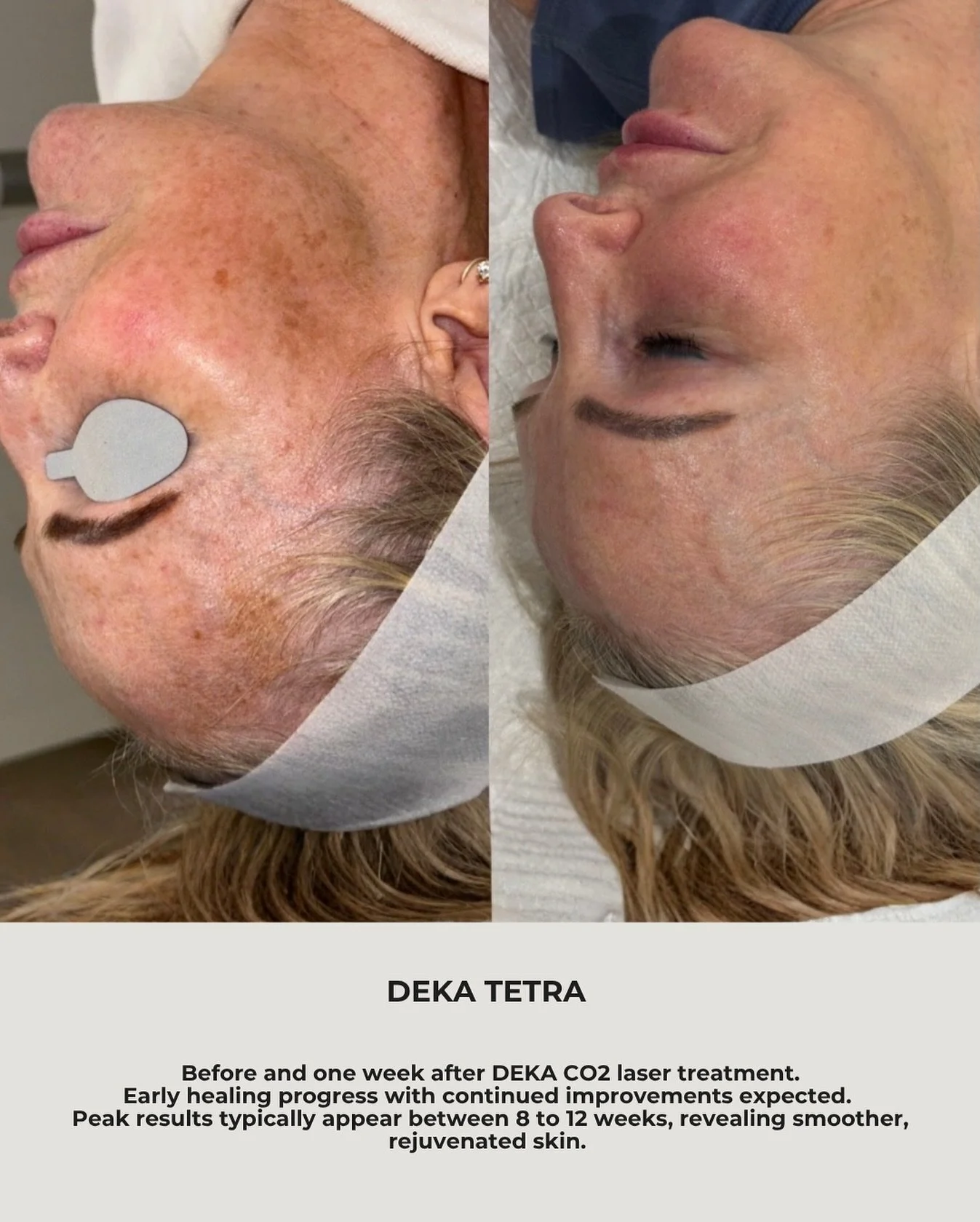 Client consent was obtained to share this photo. Results may vary from person to person. Book a consultation today with our team to discuss how this treatment can work for you.