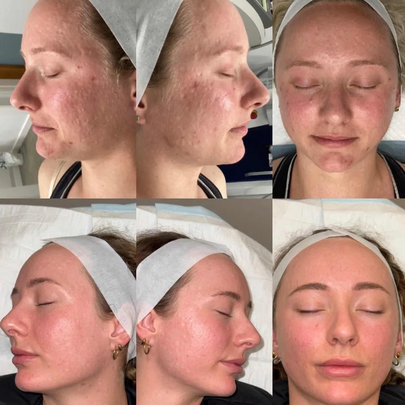 This before &amp; after holds such a special place in our hearts 🤍

Since December 2024, we&rsquo;ve been working closely with our beautiful client to treat her acne scarring and rebuild her confidence. She trusted us and the process completely, and