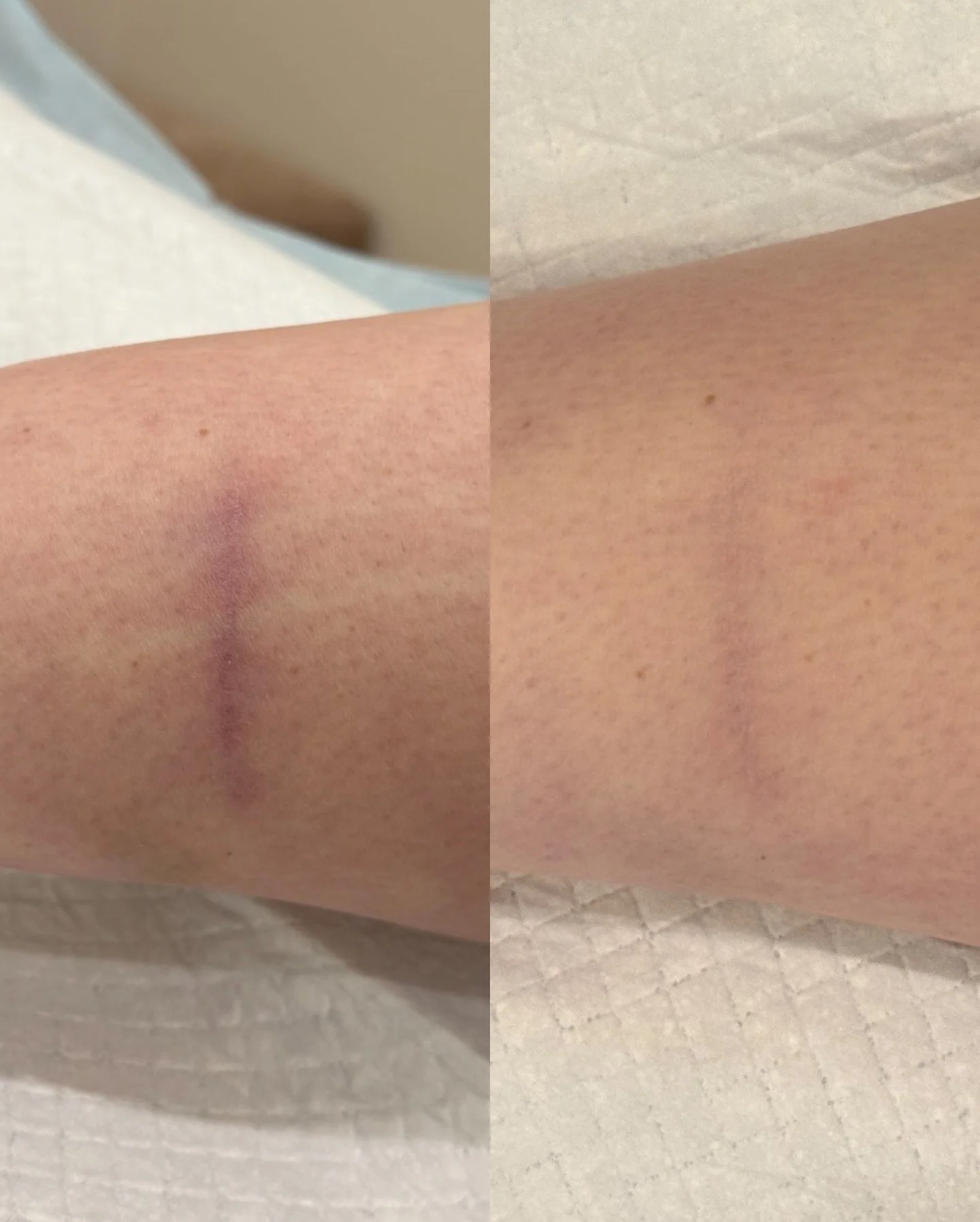 ✨ 1 session - 4 weeks apart ✨
Struggling with a scar that just won&rsquo;t fade? 
Our skilled team can help! Chat with us to see how our laser treatments can make a difference.