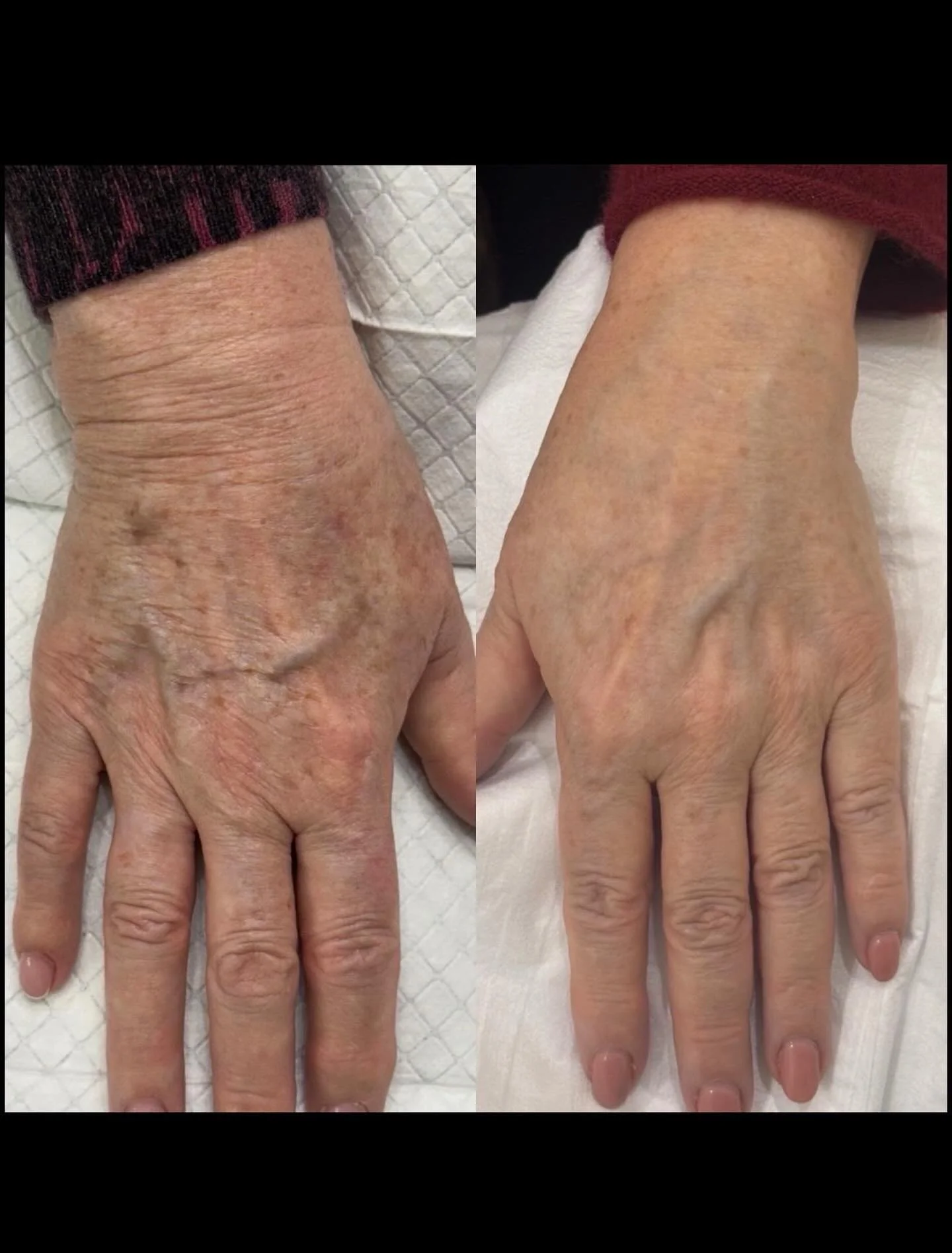 Please note: all cosmetic treatment results are unique and vary between individuals. No outcome can be guaranteed, as each person&rsquo;s anatomy, skin, healing response and lifestyle factors differ. 

Shared with permission from our lovely client &m