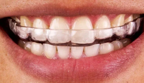 Occlusal-night-guards.jpg