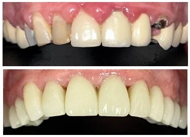 Gum health and crowns