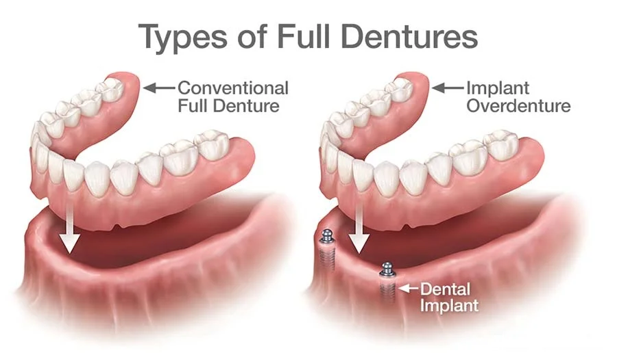 dentures-overdentures-implants-jpw-dental-fort-lee-nj.jpg