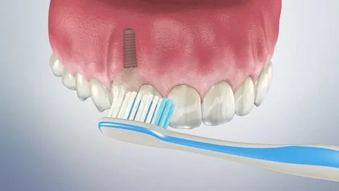 Caring for a dental implant