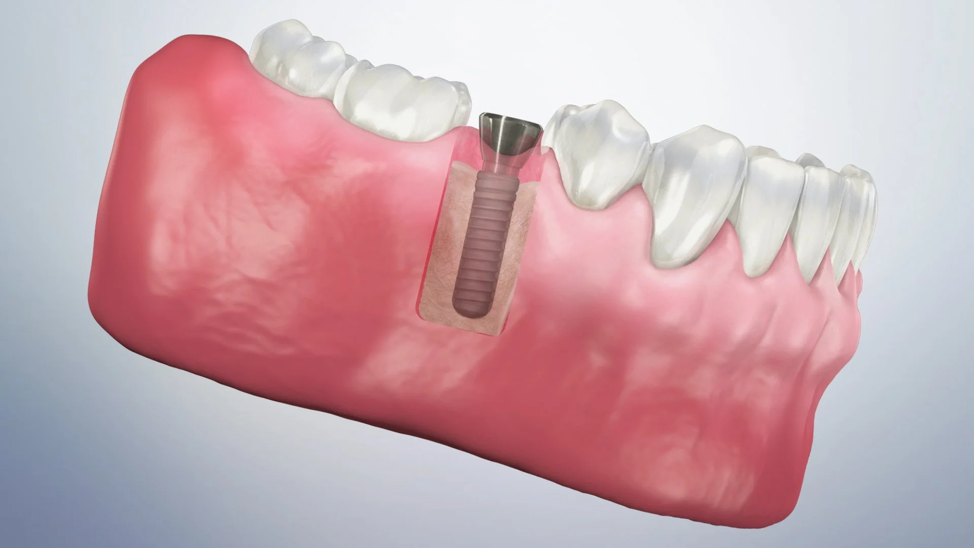 Single implant (posterior-healing cap)