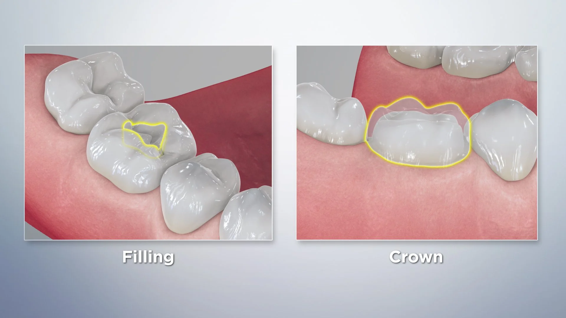 Filling vs. crown