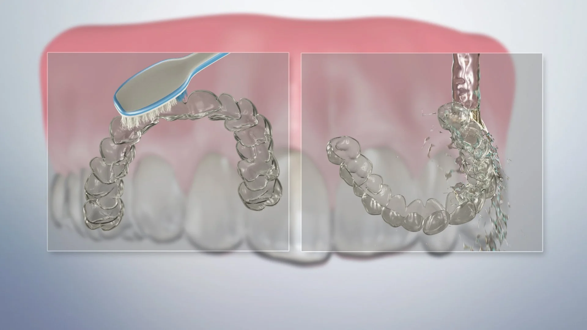 Orthodontic home care for clear aligners