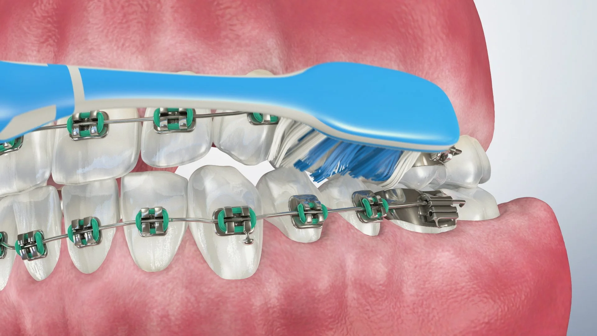 Orthodontic home care for traditional braces