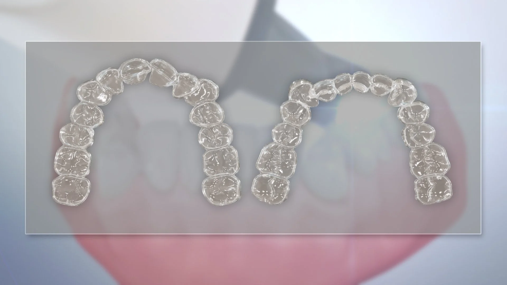 Clear aligners