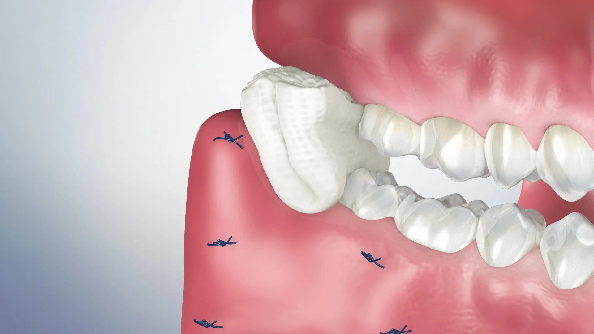 Post-operative instructions for a surgical exraction