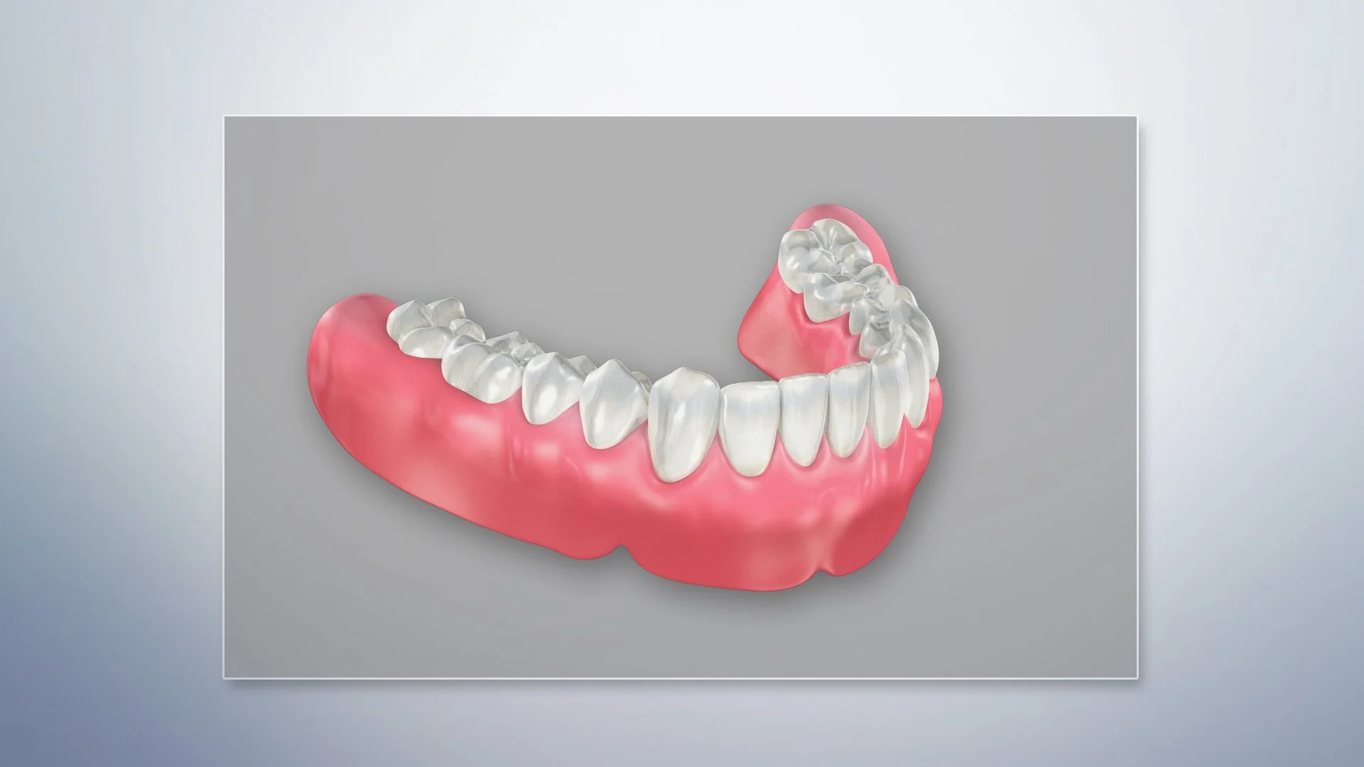 Removable complete dentures