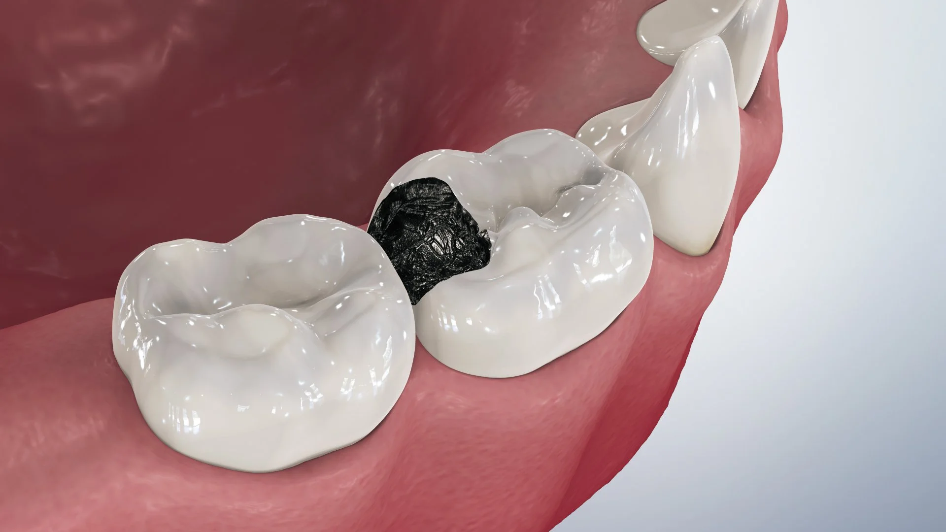 Silver Diamine Fluoride