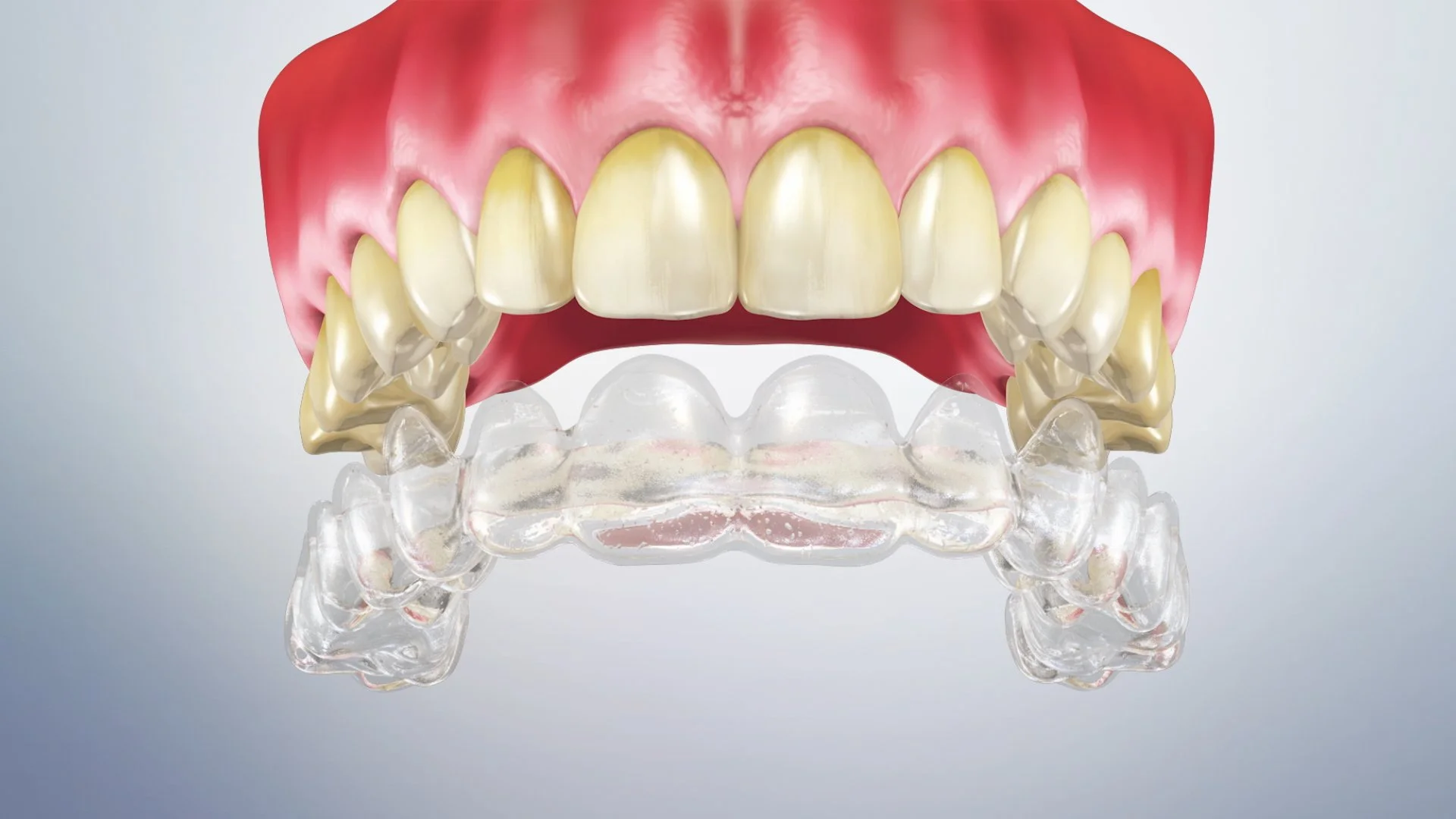 Whitening with bleaching tray