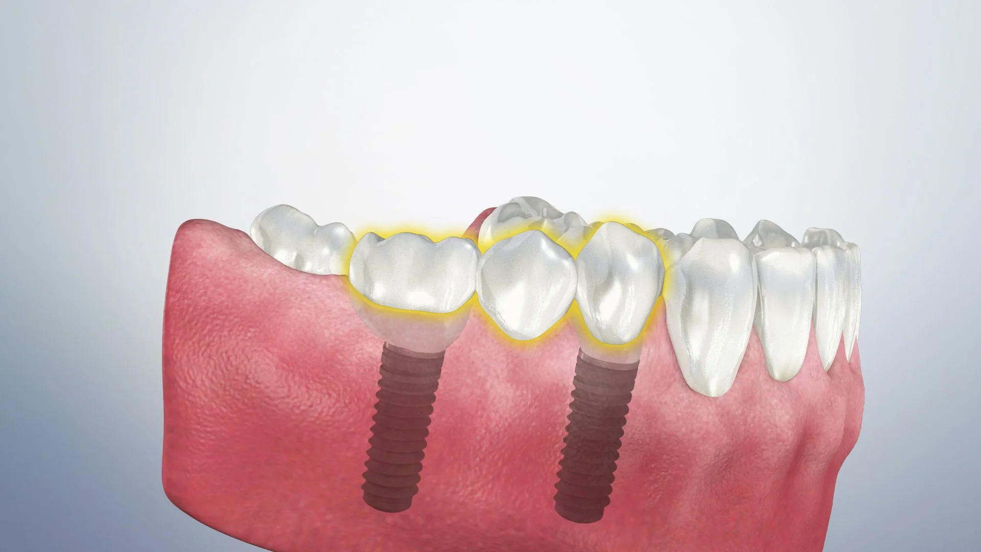 Caring for a bridge (Implant-supported)