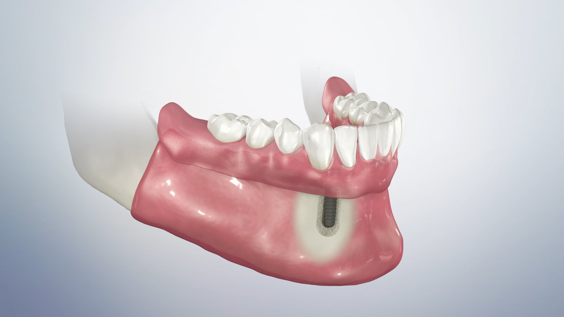 Locator retained overdenture