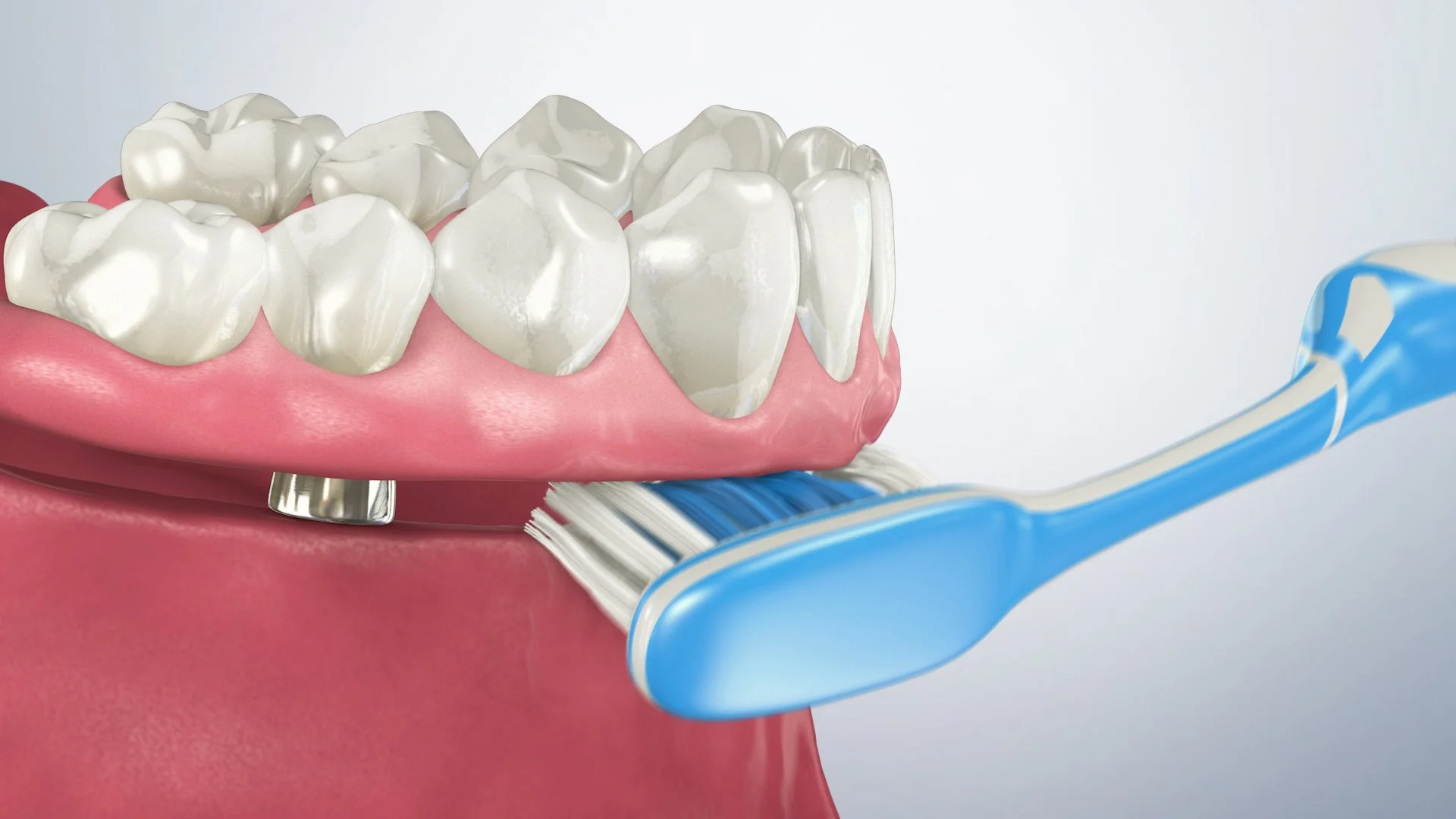 Caring for a hybrid denture