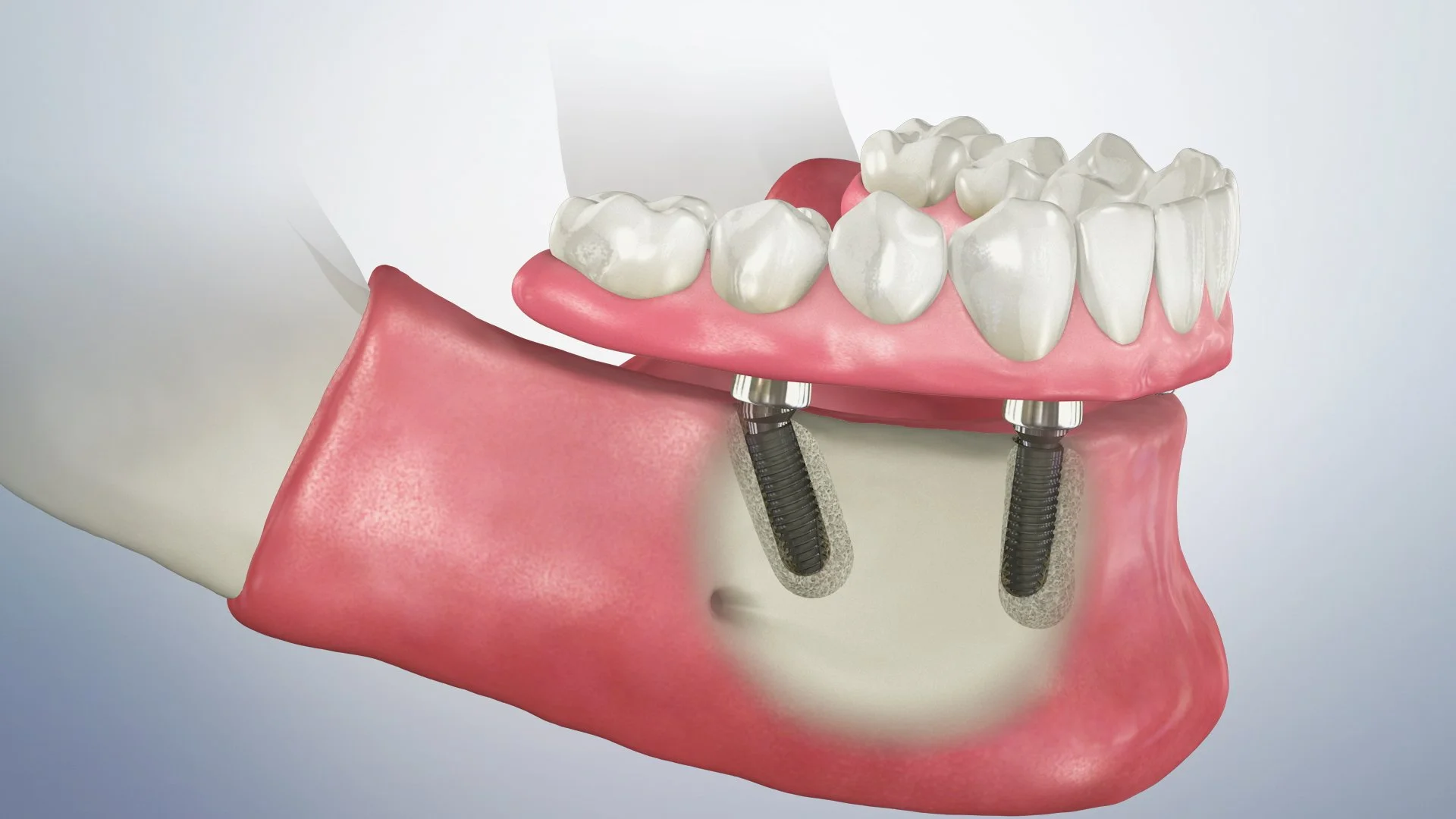 Fixed hybrid dentures