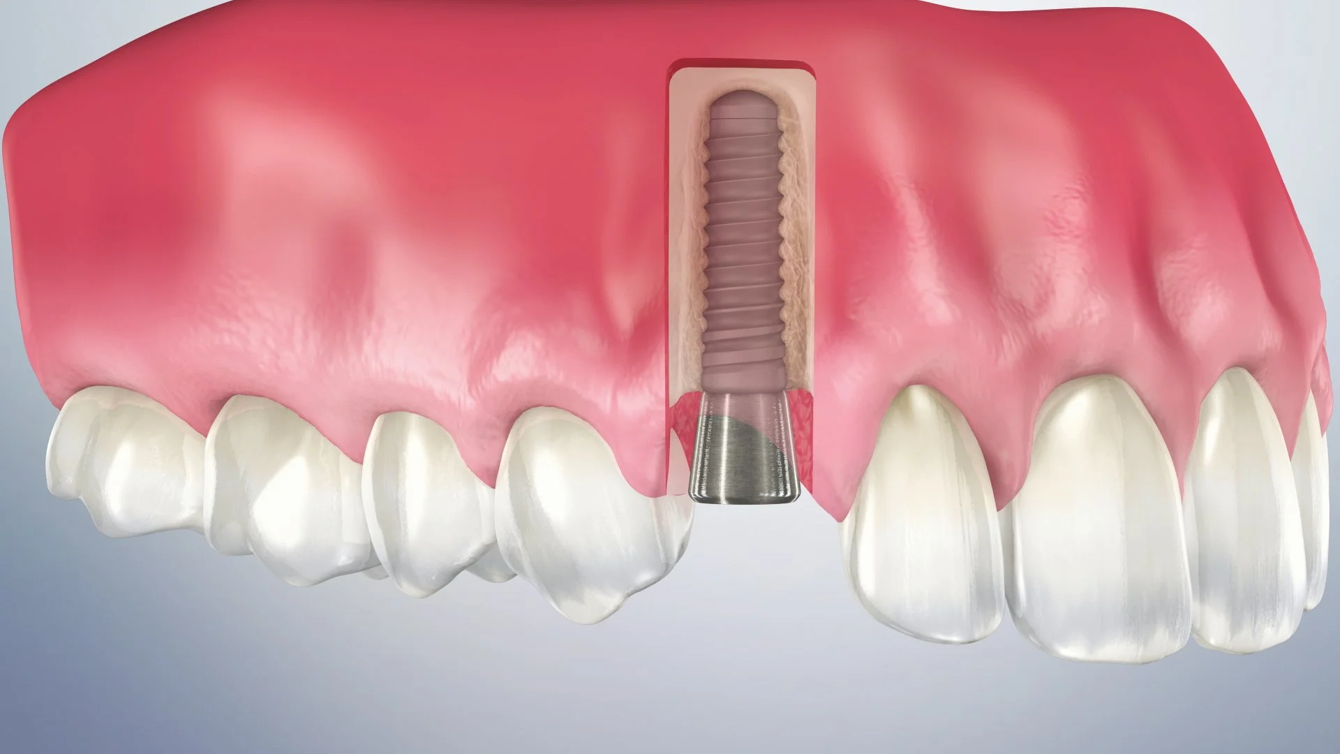 Single implant (Anterior- healing cap)