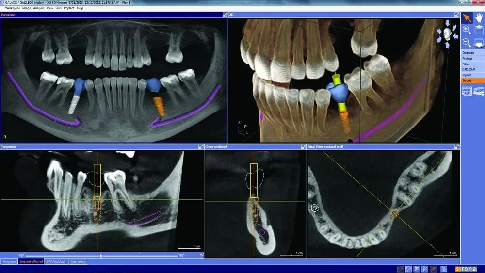 Galileo digital implant planning screen