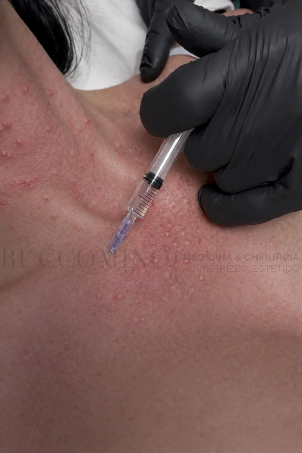 Biorivitalizzazione con aghi 