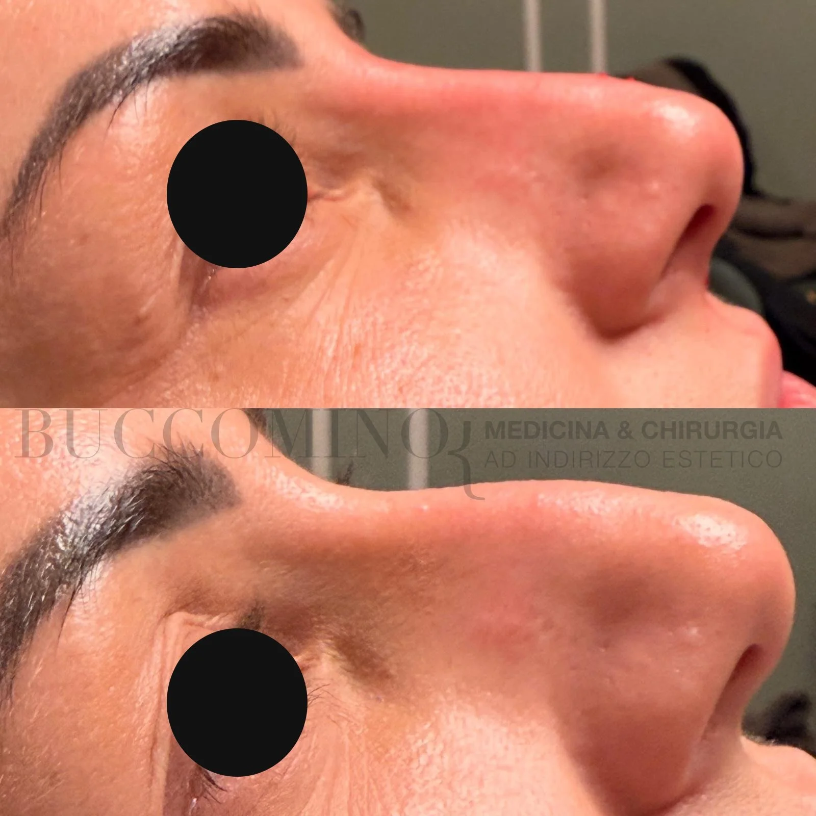 Rinofiller a Milano: cos’è, quanto dura e perché farlo solo con un medico specializzato