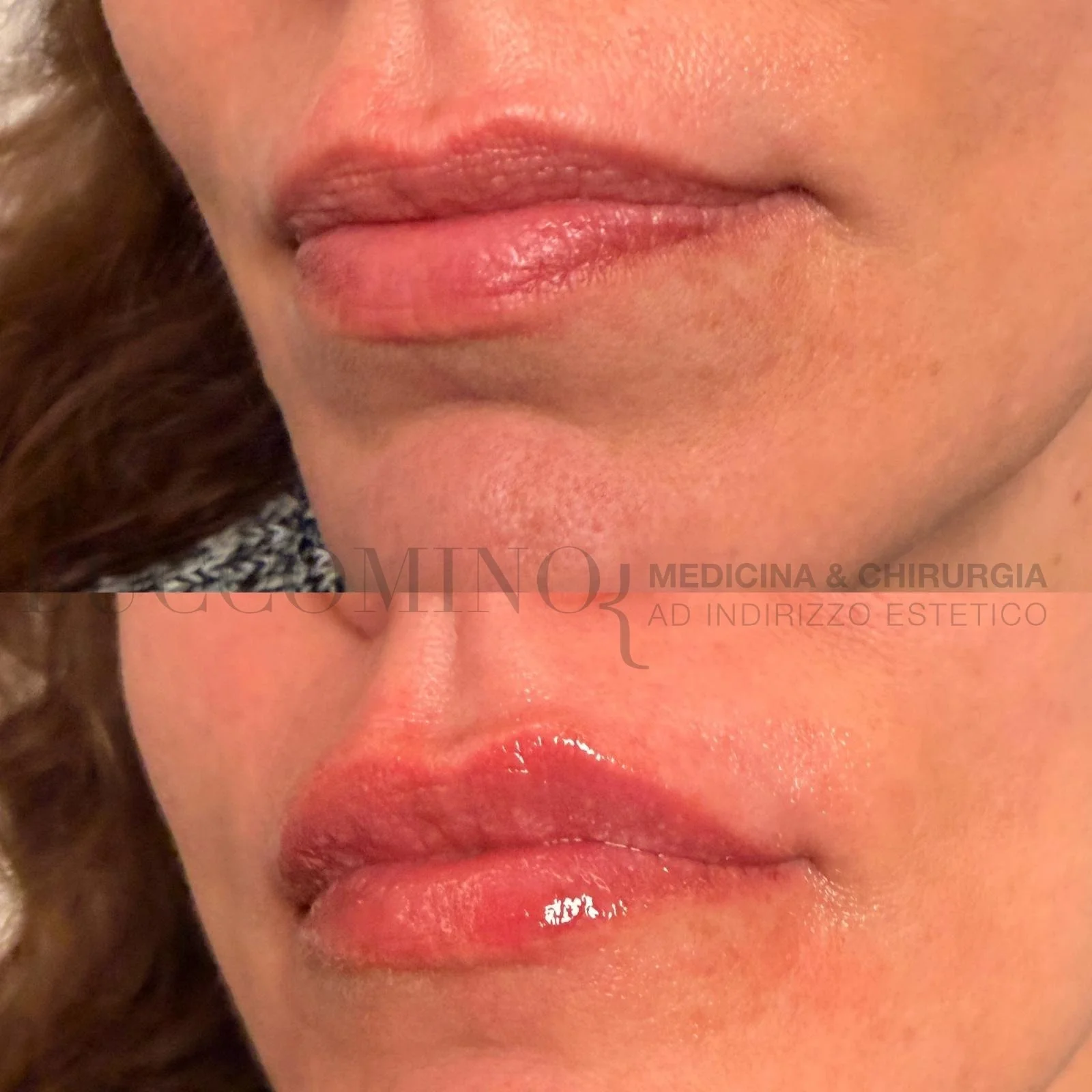 Differenza tra filler economico e filler di qualità: cosa devi sapere prima di scegliere